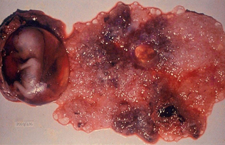 igura 2: macroscopia da Mola Hidatiforme Parcial. Perceba a presença das vilosidades e das partes fetais. Fonte: FEBRASGO, 2019