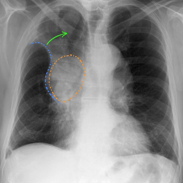 Achado acidental do sinal de S de Golden, no ápice pulmonar direito, indicado pelo traçado azul. Ele ocorre devido ao colapso do lobo por uma massa expansiva nos hilos que comprime a árvore brônquica, sendo representada pelo traçado laranja. É um sinal muito sugestivo de câncer pulmonar. A seta verde aponta para uma lesão radiotransparente com contornos radiopacos. Fonte: Radiopaedia