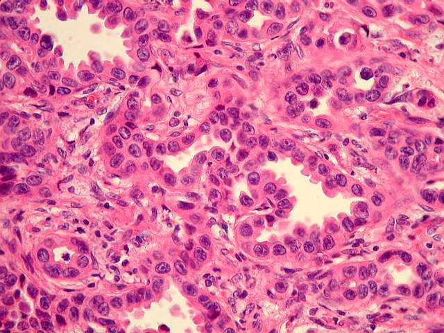 Lâmina histológica do adenocarcinoma. Perceba que as células são colunares, a proporção núcleo-citoplasma é bastante alterada e a cromatina é bem visível. Fonte: Anatpat