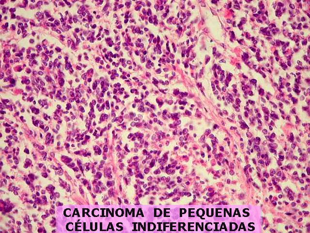 Lâmina de carcinoma de pequenas células. As células são pequenas - como é possível deduzir pelo nome - e o citoplasma é escasso. Fonte: Anatpat
