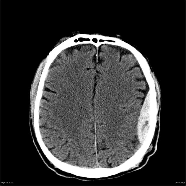 TC de crânio sem contraste com achado de hiperdensidade do lado esquerdo em formato biconvexo, com limites bem definifos, na região temporal-parietal. Fonte: Radiopaedia