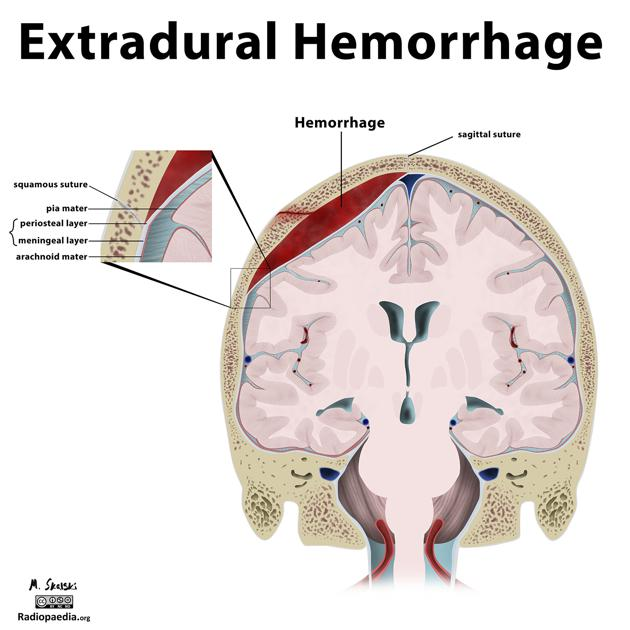 Representação da hemorragia extradural. Essas normalmente são unilaterais (95%), localizando-se principalmente nos ossos temporais e parietais (60%). Normalmente não ultrapassam as suturas cranianas, mas a depender do tamanho da lesão, podem produzir efeitos de massa, como colabamento dos ventrículos, desvio da linha média e herniações. Acometem principalmente a parte petrosa do osso temporal. Fonte: Radiopaedia
