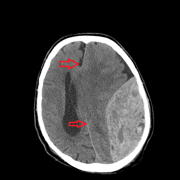 TC sem contraste com achado de hiperdensidade em formato biconvexo do lado esquerdo do paciente. As setas apontam para o desvio da linha média, que ocorre devido ao efeito de massa que o hematoma exerce sobre a massa encefálica. Além disso, há o colabamento do ventrículo esquerdo e dilatação do ventrículo direito, também devido ao efeito de massa. Fonte: Radiopaedia