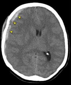Setas apontam para área hiperdensa no hemisfério direito do paciente, em formato de “meia lua” ou de “banana”. Achado característico da hemorragia subdural. Fonte: Radiology Assistant
