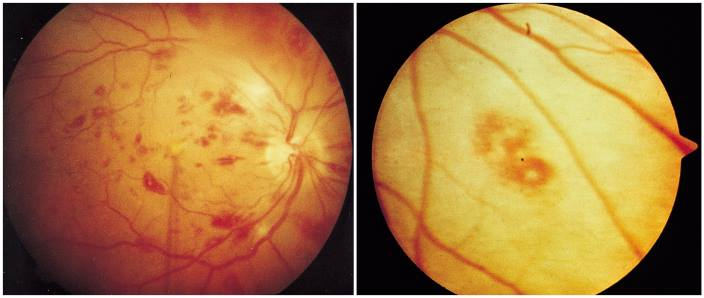 Manchas de Roth: presentes no exame de fundoscopia, são resultados de uma hemorragia retiniana. Perceba que as lesões possuem um centro mais “esbranquiçado”. Fonte: MSD Manuals
