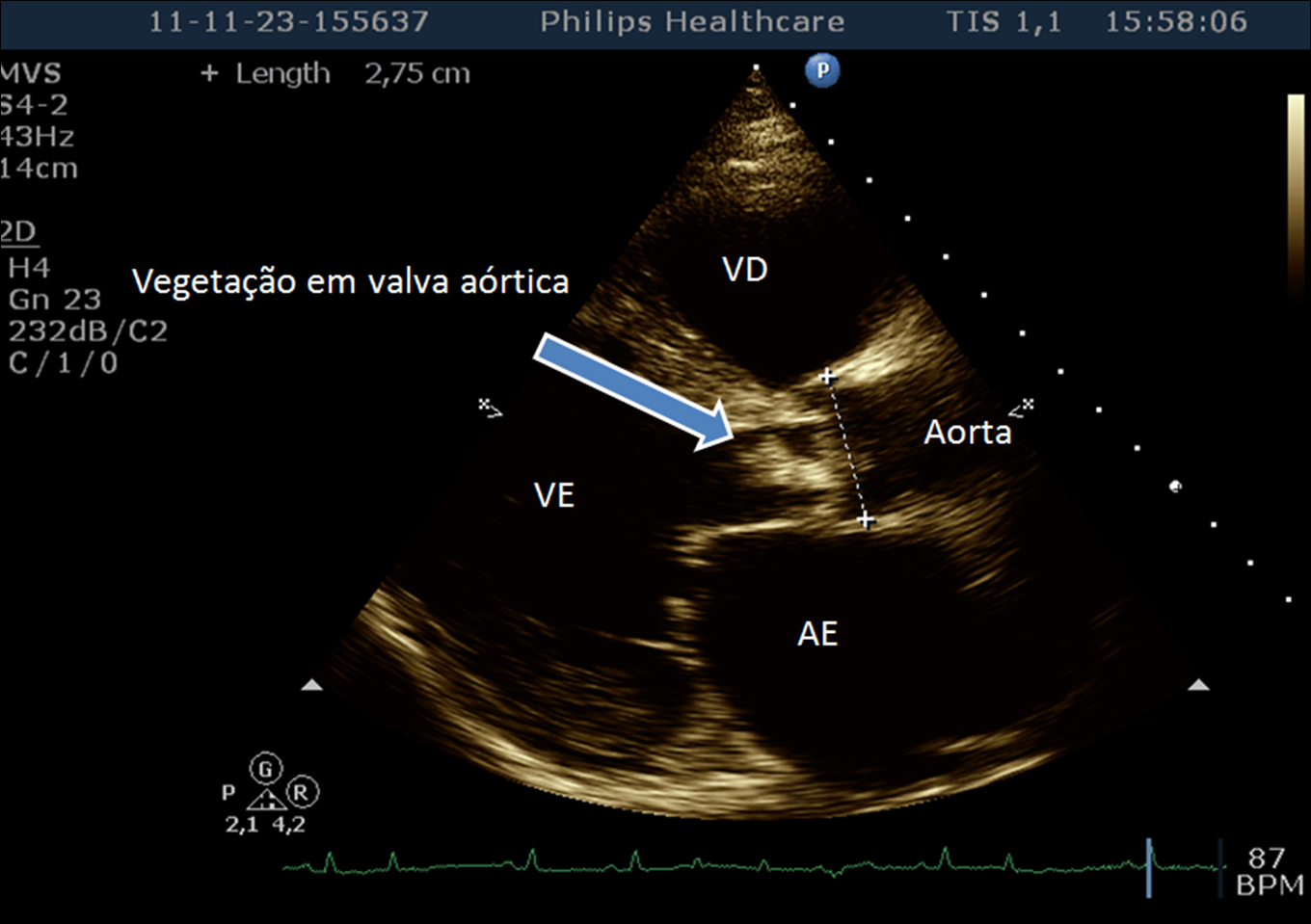 Ecocardiograma evidenciando vegetação em valva aórtica. Perceba que a vegetação tem localização na face ventricular da valva, local onde normalmente essa lesão é instalada. Fonte: CardioPapers