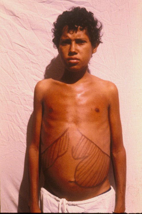 Paciente com calazar. Nele estão desenhados a o fígado e o baço em relação aos rebordos costais, evidenciando a hepatoesplenomegalia, que cursa com o aumento da circunferência abdominal. Perceba que o baço está ultrapassando a cicatriz umbilical. Fonte: São Bernardo