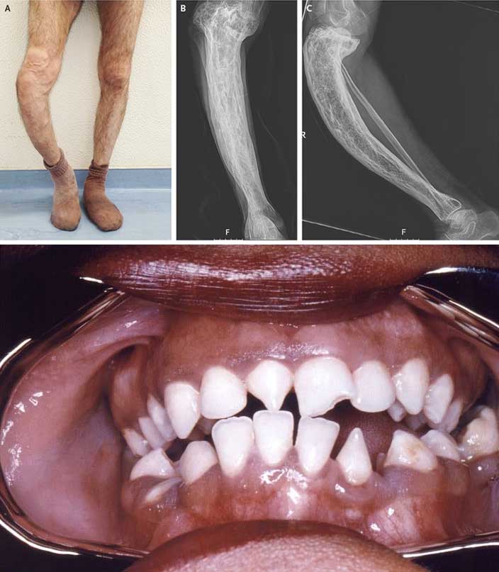 1ª imagem: Aspecto da tíbia em “lâmina de sabre”. Fonte: https://www.nejm.org/doi/full/10.1056/NEJMicm1403255. 2ª imagem: Dentes de Hutchinson, caracterizados por uma deformidade triangular nos dentes. Fonte: https://www.nejm.org/doi/full/10.1056/NEJMicm1403255