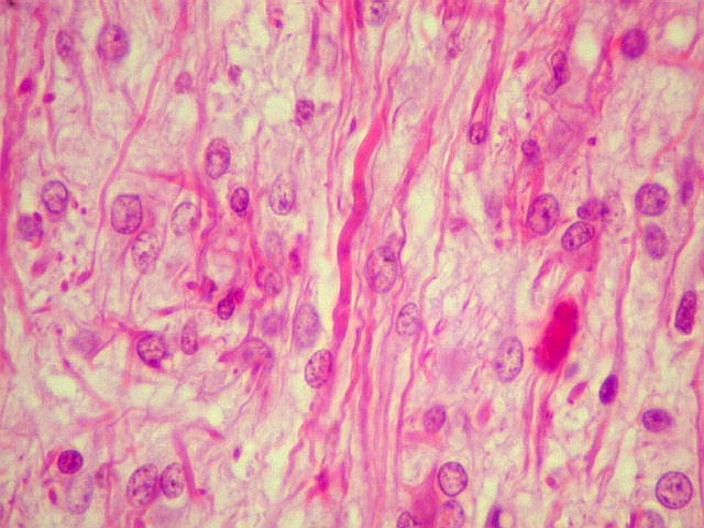 Lâmina de um astrocitoma pilocítico. O tumor tem o nome “pilocítico” devido ao prolongamento dos astrócitos neoplásicos, que lembram “pelos”, como em uma cabeleira. Perceba que, nesse tumor, há poucas atipias celulares. Fonte: Anapat