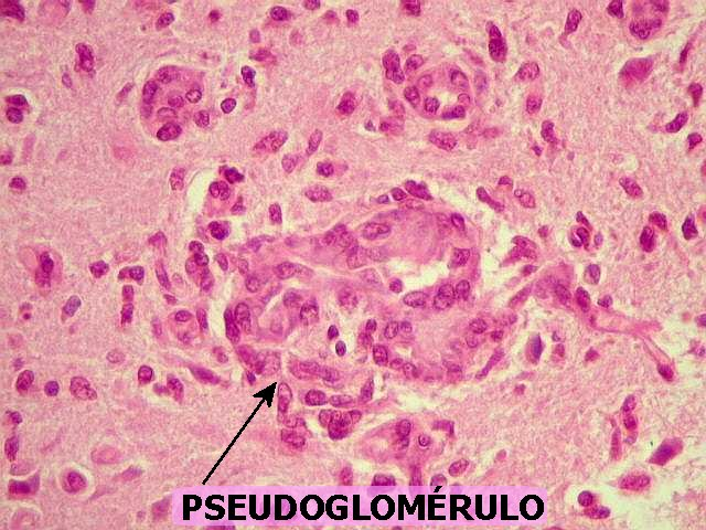 Lâmina histológica apresentando um pseudoglomérulo. Isso ocorre quando há uma proliferação vascular muito intensa, que mimetiza capilares glomerulares. Esse é um achado muito característico dos glioblastomas. Fonte: Anapat
