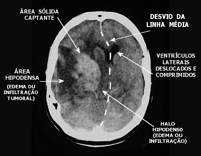 Tomografia de crânio com contraste de um glioblastoma, demonstrando uma grande lesão no hemisfério direito. Perceba que essa lesão é heterogênea, de centro hiperdenso circundando por áreas hipodensas, que podem corresponder a edema ou infiltrações neoplásicas. Há deslocamento da linha média, e os ventrículos estão colabados e deslocados. Fonte: Anapat