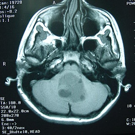 Ressonância magnética (RM) em T1, sem contraste, de um meduloblastoma. Perceba que a lesão é heterogênea e bem delimitada. Fonte: Anapat