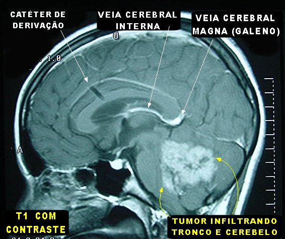 RM em T1, com contraste, de um meduloblastoma. Fonte: Anapat