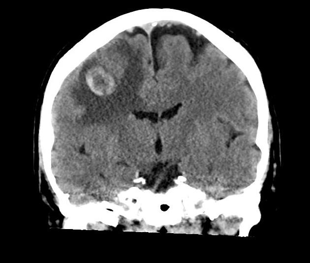 TC sem contraste em corte coronal de paciente com metástase cerebral de melanoma. Perceba que a lesão é bem delimitada e é hiperdensa em relação ao córtex, devido ao pigmento da melanina presente no tumor. A área hipodensa nas periferias da lesão é característica do edema circunjacente. Fonte: Radiopaedia