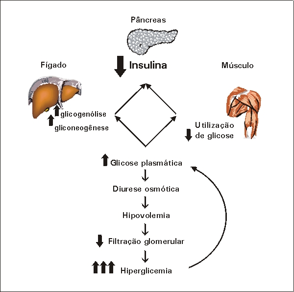 Diagrama resumindo a fisiopatologia da cetoacidose diabética. Fonte: Jornal de Pediatria (https://www.scielo.br/j/jped/a/pG3Rny3BZ6Jfk3sSYsdbNyS/?lang=pt)