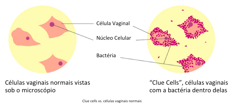 Representação do que seriam as “clue cells”: são células do epitélio vaginal normais descamadas, com cocobacilos aderidos ao seu redor. Fonte: Young Woman’s Health (https://youngwomenshealth.org/2015/02/03/vaginose-bacteriana/)