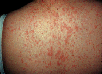 O exantema do sarampo é maculopapular e morbiliforme de coloração avermelhada. Em crianças, a extensão do exantema normalmente está associada ao grau de severidade da doença. Fonte: UpToDate.
