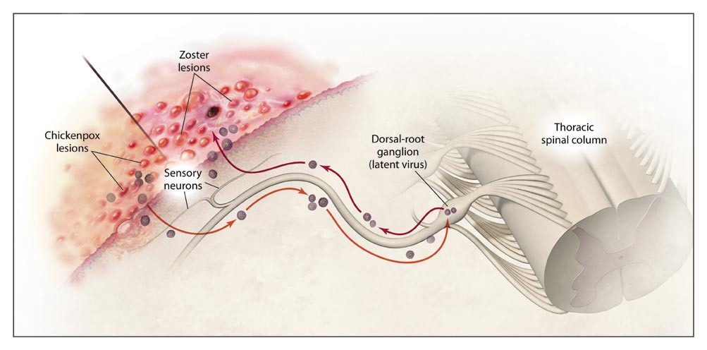 Imagem exemplificando a fisiopatologia da herpes-zóster. Fonte: Dr. Carlos Leão (https://www.drcarlosleao.com.br/herpes-zoster/)