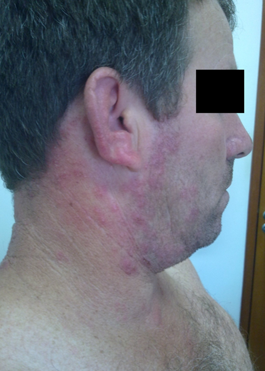 Paciente com síndrome de Hawsay-Hunt. Perceba a hiperemia no pavilhão auditivo. Fonte: Sociedade Brasileira de Medicina Tropical (https://www.sbmt.org.br/portal/relato-de-caso-sindrome-de-ramsey-hunt-apos-tratamento-antimonial-contra-leishmaniose-cutanea/)
