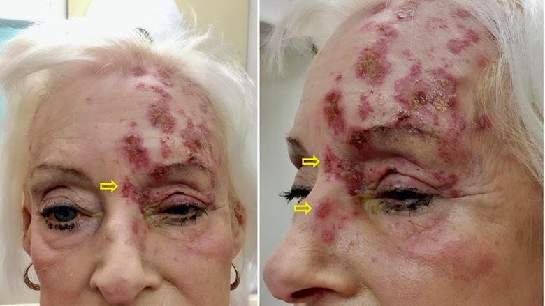 Paciente apresentando sinal de Hutchinson (seta amarela). Fonte: UFRGS (https://www.ufrgs.br/telessauders/perguntas/como-diagnosticar-e-manejar-o-herpes-zoster-oftalmico/)