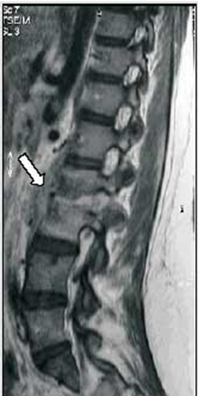 Ressonância apontando para fusão dos corpos vertebrais L1 e L2. Achadomuito sugestivo do Mal de Pott, característico da osteomielite tuberculosa. Fonte: https://www.jornaldepneumologia.com.br/details/1146/pt-BR/espondilite-tuberculosa-em-adolescente