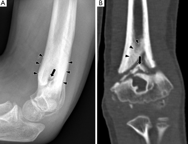 Fonte: Lee YJ, Sadigh S, Mankad K, Kapse N, Rajeswaran G. The imaging of osteomyelitis. 2016.
