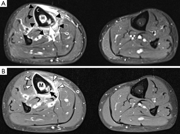 As imagens mostram uma ressonância da tíbia direita (patológica) e esquerda (normal) de uma paciente com osteomielite. Fonte: Lee YJ, Sadigh S, Mankad K, Kapse N, Rajeswaran G. The imaging of osteomyelitis. 2016.