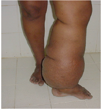 Paciente com linfedema crônica - elefantíase. Fonte: SICILIANO, R. F. et al., Tratado de Infectologia.