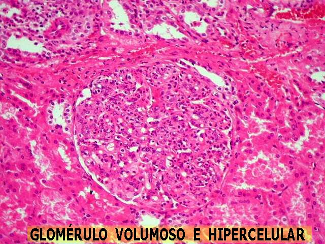 Glomerulonefrite difusa aguda na lâmina histológica. Os glomérulos encontram-se dilatados e com presença de células polimorfonucleadas (neutrófilos). Fonte: Anatpat (http://anatpat.unicamp.br/laminfl30.html)