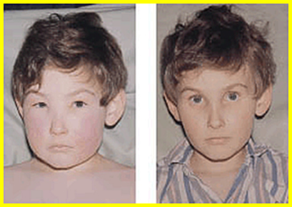 Paciente com edema facial, diagnosticado com GNDA. Fonte: MediFoco (https://medifoco.com.br/glomerulonefrite-pos-estreptococica/)