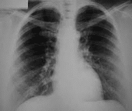 Raio-X apresentado opacidades difusas multifocais em ambos os pulmões. Associados à clínica e exames laboratoriais, é característico da síndrome de Loeffler. Fonte: Scielo (https://www.scielo.br/j/jpneu/a/TmF8YF8DnNKN9HcQZBBCtRh/?lang=pt)