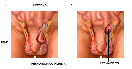 Hérnia Inguinal