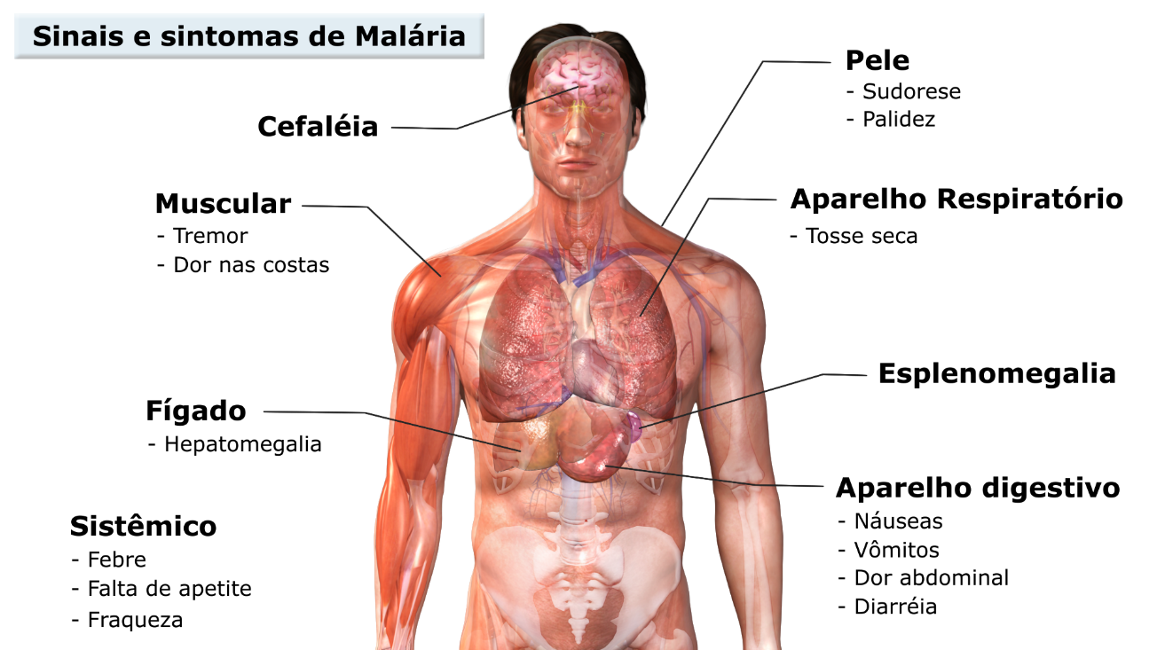 Sinais e sintomas da malária. Fonte: UNASUS (https://ares.unasus.gov.br/acervo/handle/ARES/10330)