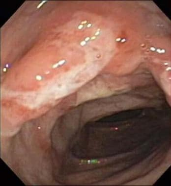 Colonoscopia de cólon descendente de paciente com doença de Crohn. Perceba a presença da úlcera e de inflamação das paredes. Fonte: Medscape (https://emedicine.medscape.com/article/172940-overview)
