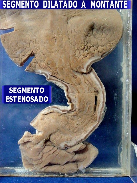 Segmento espesso no intestino delgado. Isso ocorre devido à fibrose, consequência da inflamação crônica. Fonte: Anatpat (http://anatpat.unicamp.br/pecastgi21.html)
