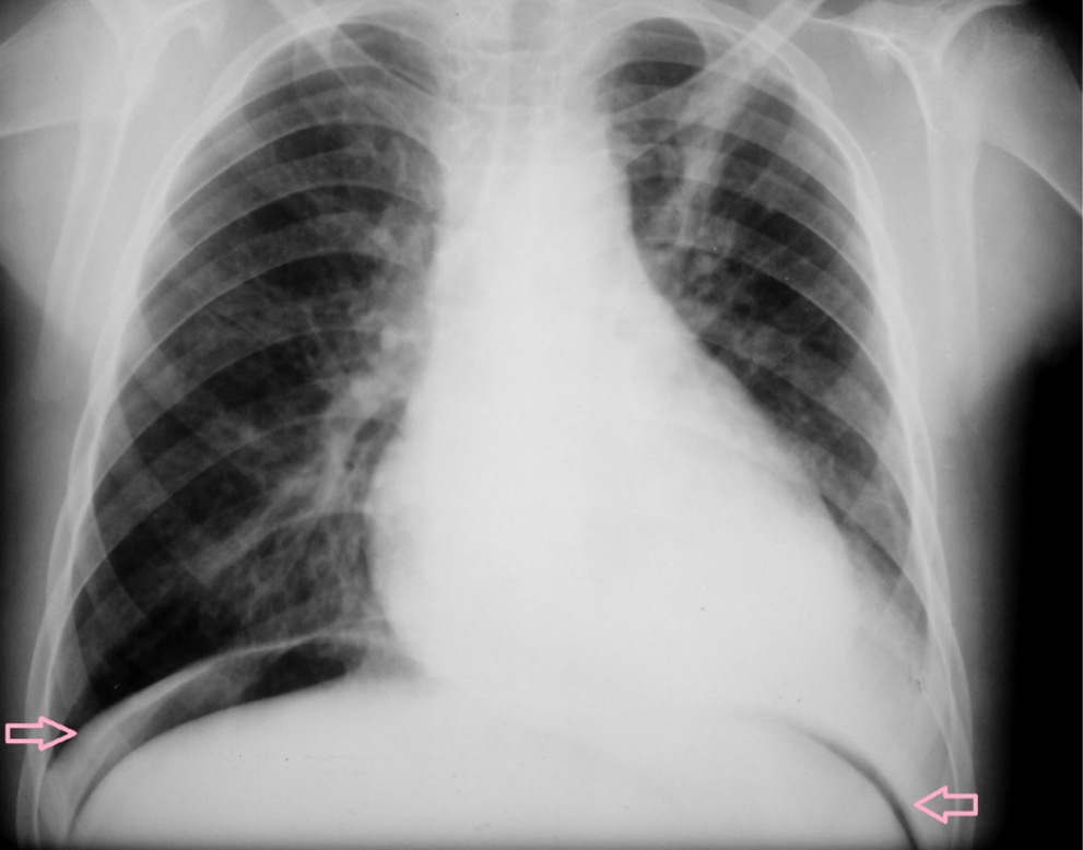 Raio-X com achado de pneumoperitônio (setas rosas). O pneumoperitônio pode ser um achado da perfuração das alças intestinais. Fonte: MedicinaNet (https://www.medicinanet.com.br/conteudos/casos/2159/pneumoperitonio_e_outros_achados_na_radiografia_toracica.htm)