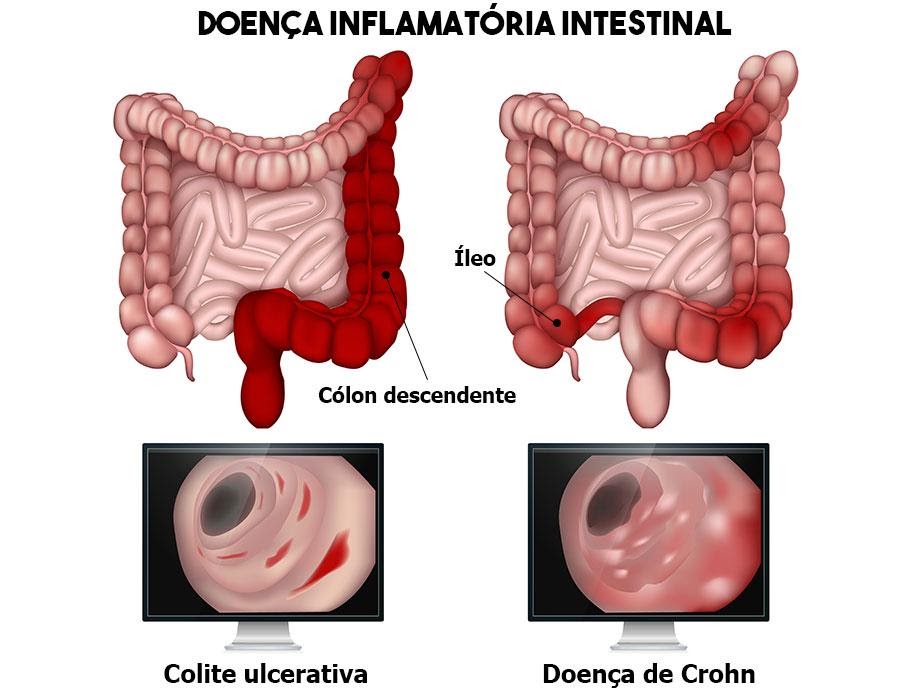 Principais diferenças entre a doença Crohn e a retocolite ulcerativa. Fonte: MD Saúde (https://www.mdsaude.com/gastroenterologia/doenca-de-crohn/)