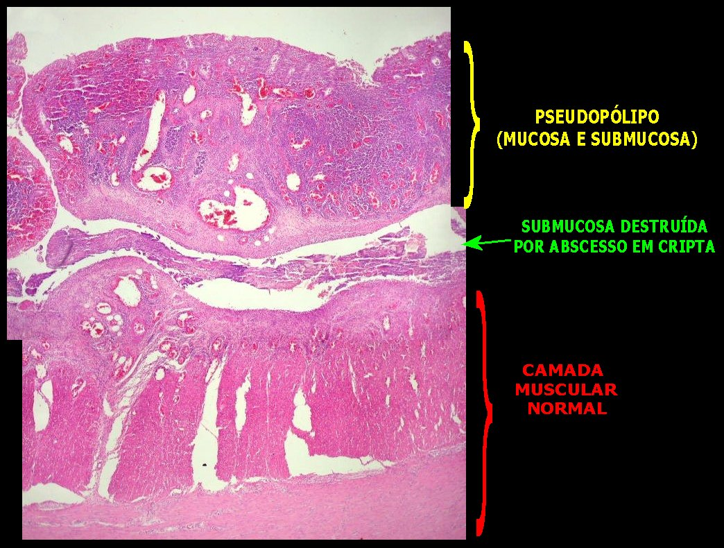 Lâmina histológica de paciente com colite ulcerativa. Os pseudopólipos, achados frequentes na lâmina, são resultado da regeneração frequente na mucosa. Para mais, perceba que a camada muscular se encontra normal, e as lesões afetam apenas as túnicas mucosa e submucosa. Fonte: Anatpat