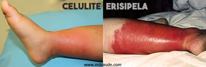 Diferenciação entre a celulite e a erisipela. Perceba que, na celulite, os limites da lesão são mais imprecisos e a lesão é menos eritematosa. Fonte: MD.Saúde