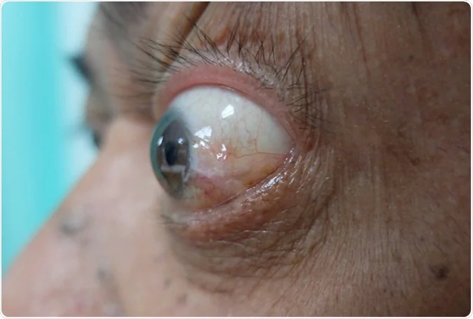 Exoftalmia. É definida como a protrusão do globo ocular devido ao aumento do volume orbitário. Fonte: News Medical (https://www.news-medical.net/health/What-is-Exophthalmos-(Portuguese).aspx)