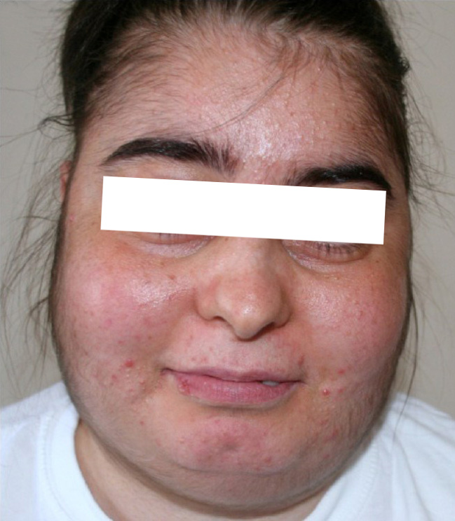 Paciente com Síndrome de Cushing. Perceba o acúmulo de gordura na face (face de “lua cheia”), o hirsutismo e a acne. Fonte: Multidisciplinary Respiratory Medicine