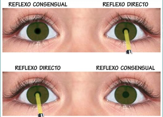 Representação dos reflexos direto e consensual. Fonte: Optimetria Cuidados Primários da Visão