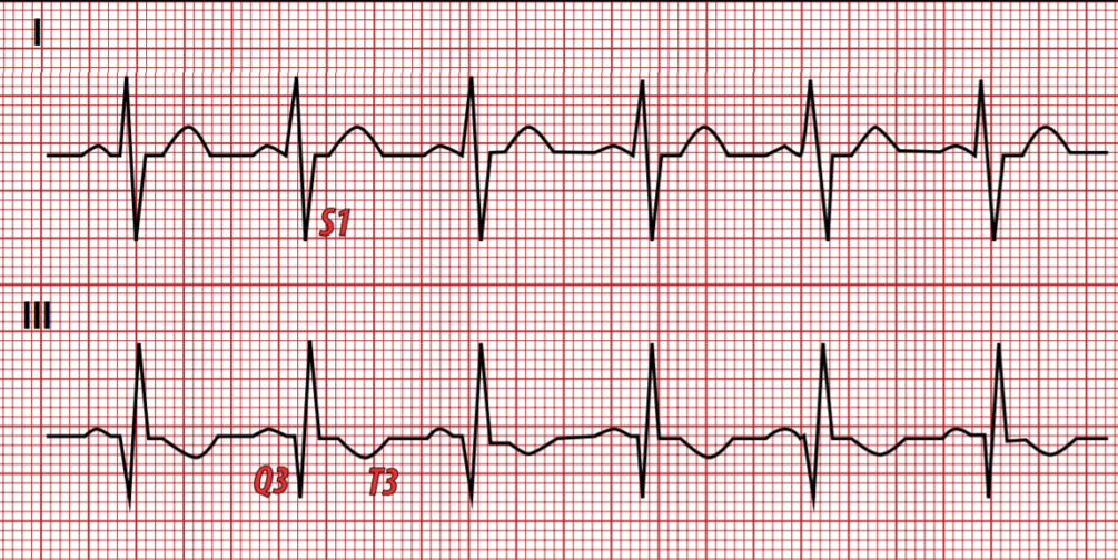 Eletrocardiograma