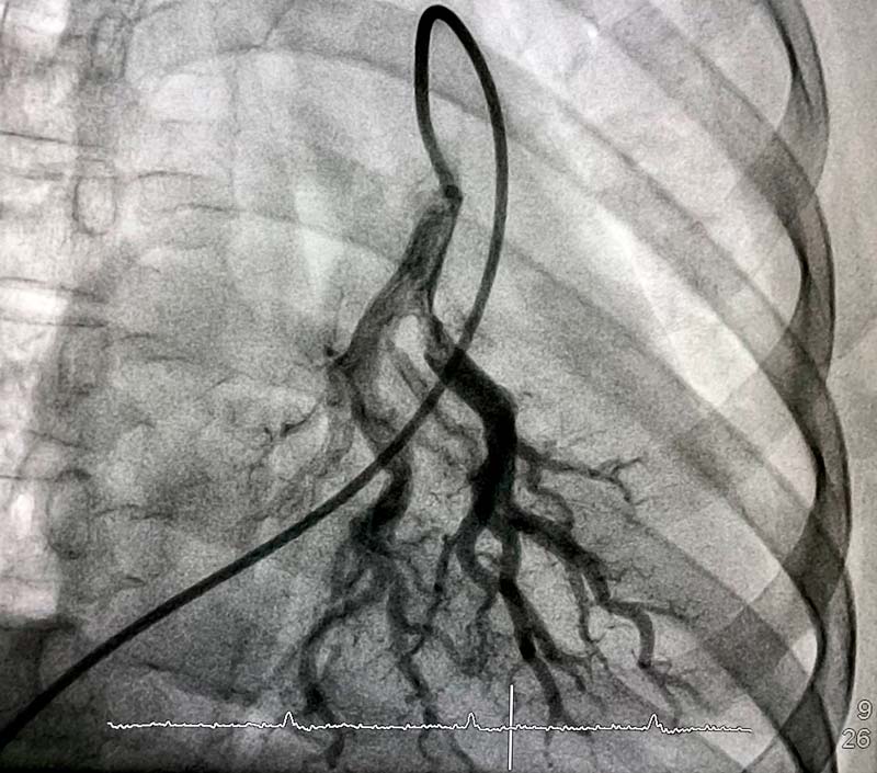 Arteriografia Pulmonar