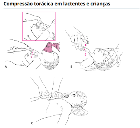Compressões torácicas e estabelecimento de via aérea avançada