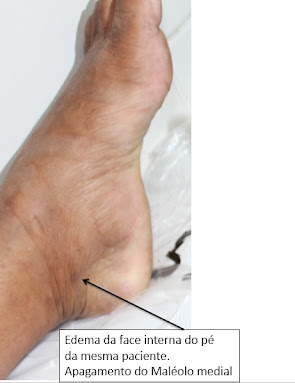 Edema maleolar. Fonte: Universidade Aberta do SUS (http://production.latec.ufms.br/modulos/chick/modulos/bancoImg/)
