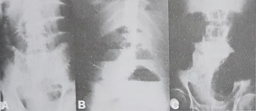 Como diagnosticar o abdome agudo obstrutivo?