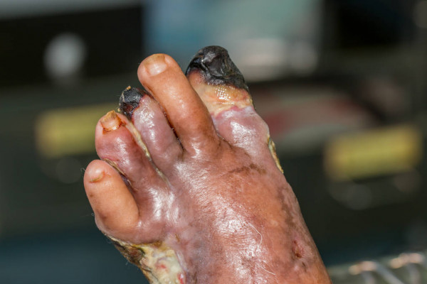 Úlcera isquêmica. É caracterizada por ser dolorosa, sem tecido de granulação, presença de gangrena seca e ausência de pulsos. Fonte: VILAR, Lucio. et al. Endocrinologia Clínica, 2020.
