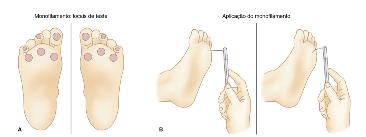 Figura A: locais de aplicação do monofilamento. Figura B: modo de aplicação do monofilamento. Deve-se posicioná-lo nas regiões indicadas, e realizar uma pressão na região plantar até que a haste se incline. Dessa forma, realizando-se pressão de 10g sobre a região.Fonte: VILAR, Lucio. et al. Endocrinologia Clínica, 2020.