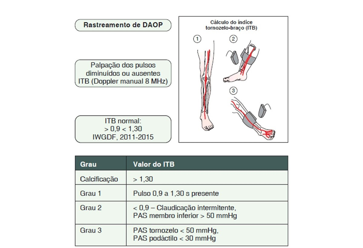 Realização do ITB para rastreamento da doença arterial obstrutiva periférica (DAOP), também chamada de doença arterial periférica. Fonte: VILAR, Lucio. et al. Endocrinologia Clínica, 2020.
